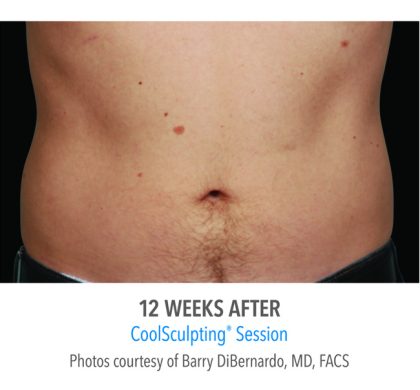 Coolsculpting Before & After Patient #335