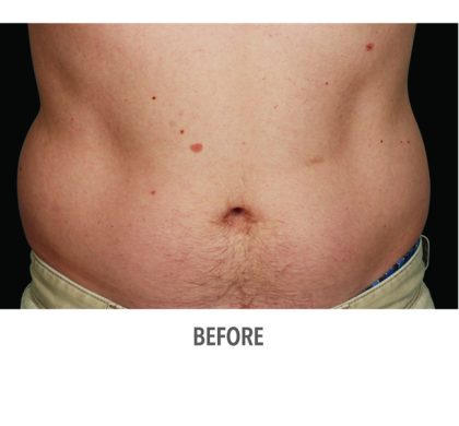 Coolsculpting Before & After Patient #335