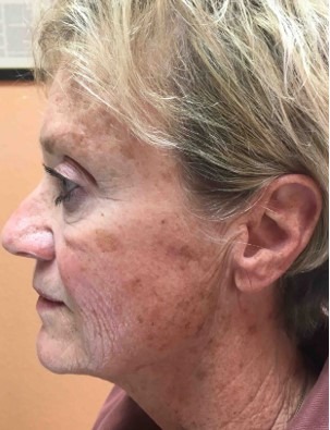Mini Face Lift Before & After Patient #133