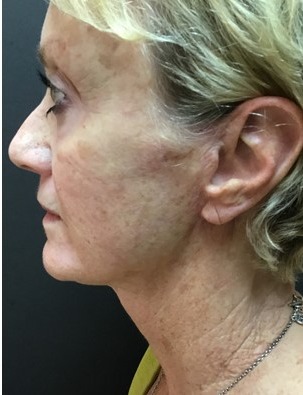 Mini Face Lift Before & After Patient #133