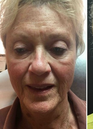 Mini Face Lift Before & After Patient #133