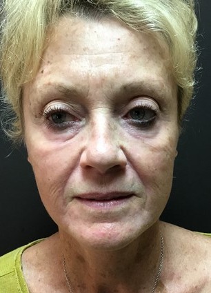 Mini Face Lift Before & After Patient #133
