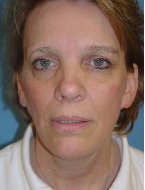 Mini Face Lift Before & After Patient #136