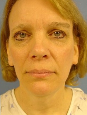 Mini Face Lift Before & After Patient #136