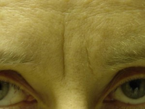 Glabella Before & After Patient #250