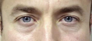 Lower Blepharoplasty Before & After Patient #71