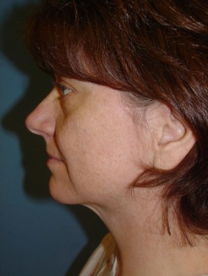 Facelift Before & After Patient #89
