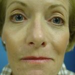 Fat Transfer Before & After Patient #338