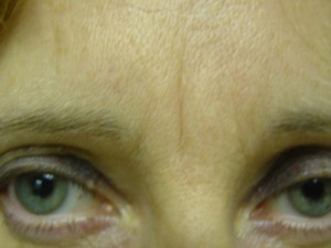 Glabella Before & After Patient #250