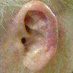 Ear Reconstruction Before & After Patient #174