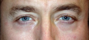 Lower Blepharoplasty Before & After Patient #71