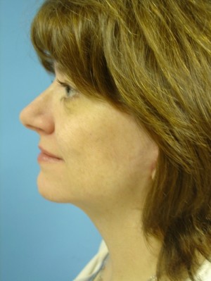 Facelift Before & After Patient #89