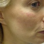 Fat Transfer Before & After Patient #338