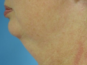 Neck Liposuction Before & After Patient #150