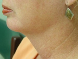 Neck Liposuction Before & After Patient #150