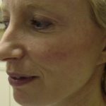 Fat Transfer Before & After Patient #338