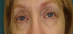 Upper and Lower Blepharoplasty Before & After Patient #88