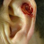 Ear Reconstruction Before & After Patient #176