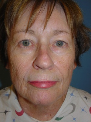 Facelift Before & After Patient #109