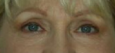 Upper and Lower Blepharoplasty Before & After Patient #88