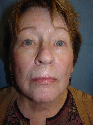 Facelift Before & After Patient #109