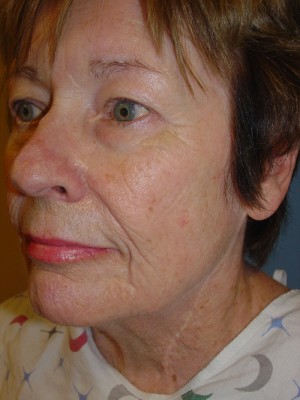 Facelift Before & After Patient #109
