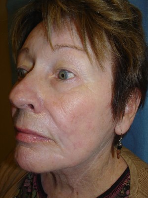 Facelift Before & After Patient #109