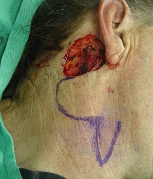 Neck Reconstruction Before & After Patient #196