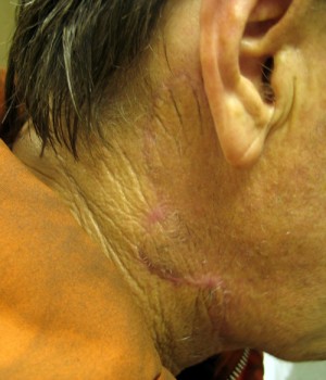 Neck Reconstruction Before & After Patient #196