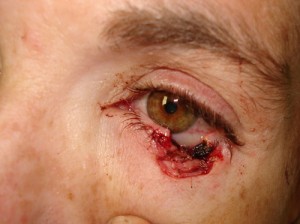 Eyelid Reconstruction Before & After Patient #188