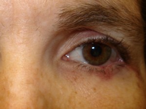 Eyelid Reconstruction Before & After Patient #188