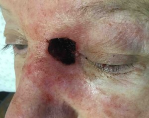Nose Reconstruction Before & After Patient #226