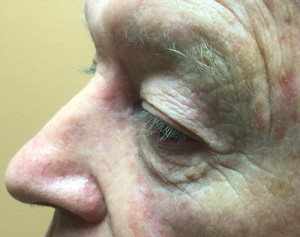 Nose Reconstruction Before & After Patient #226