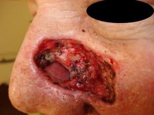 Nose Reconstruction Before & After Patient #225
