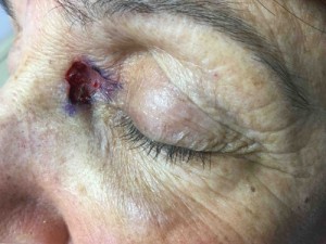 Eyelid Reconstruction Before & After Patient #186