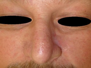 Nose Reconstruction Before & After Patient #225