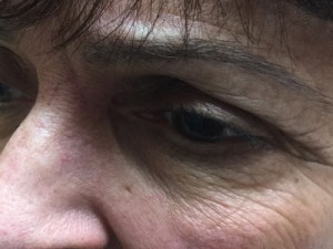 Eyelid Reconstruction Before & After Patient #186