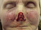 Nose Reconstruction Before & After Patient #224