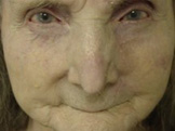 Nose Reconstruction Before & After Patient #224