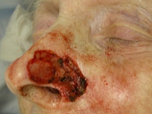Nose Reconstruction Before & After Patient #223