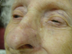 Nose Reconstruction Before & After Patient #223
