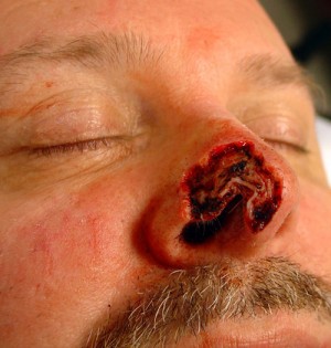 Nose Reconstruction Before & After Patient #199