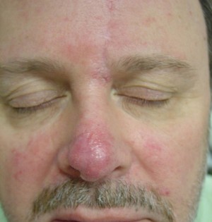 Nose Reconstruction Before & After Patient #199