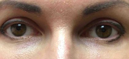 Periorbital Filler Before & After Patient #244