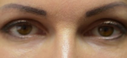 Periorbital Filler Before & After Patient #244