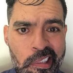 Facial Paralysis Before & After Patient #1515