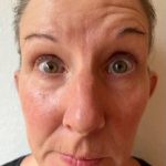 Facial Paralysis Before & After Patient #1516