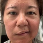 Facial Paralysis Before & After Patient #1517