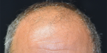 Hair Restoration Before & After Patient #1490