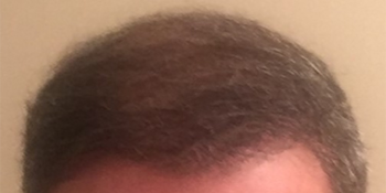 Hair Restoration Before & After Patient #1490